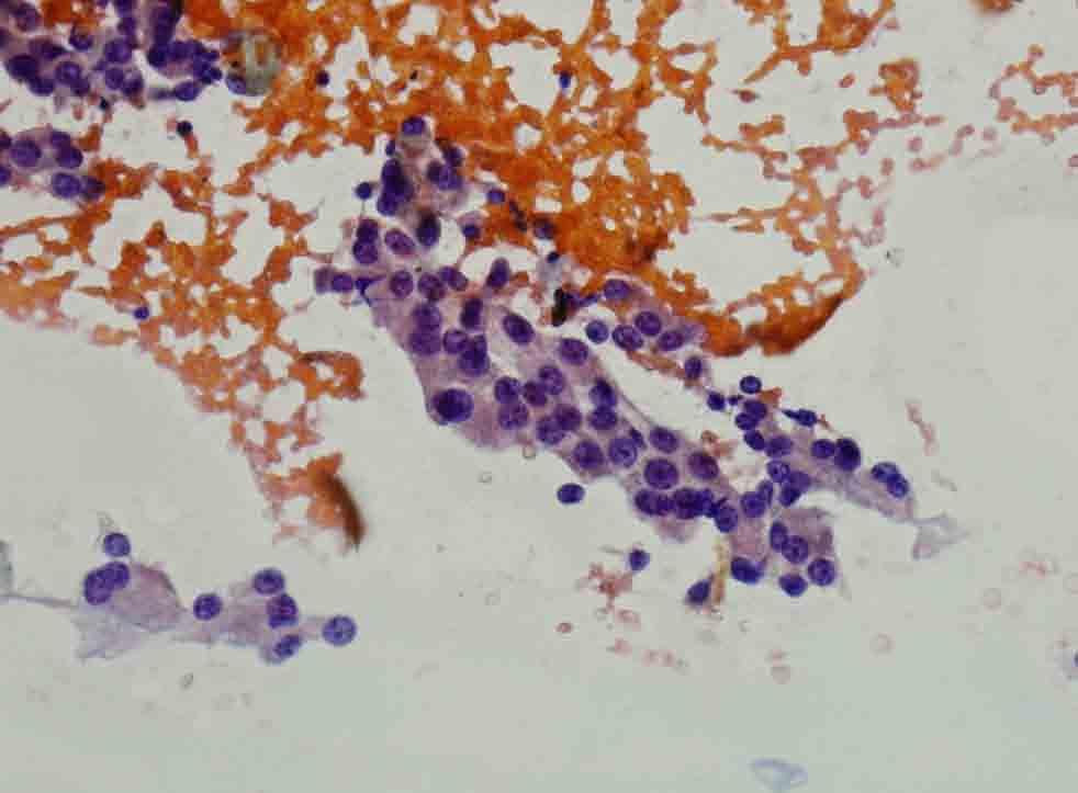 Lung, RUL, CT-guided FNA: Papanicolaou stain Presentation material is for