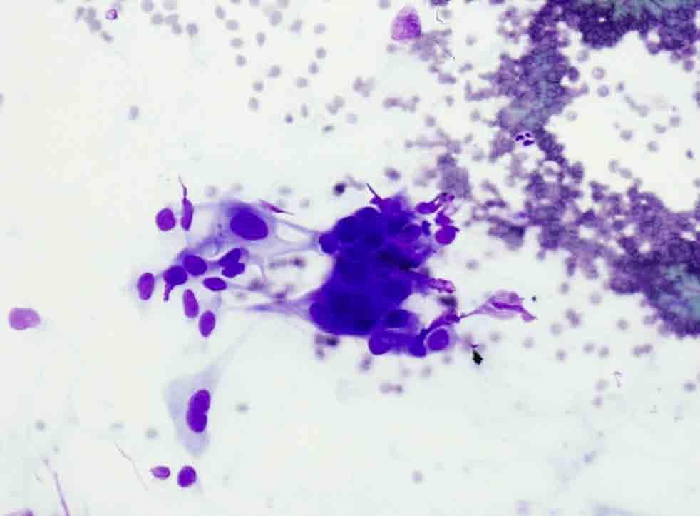 Case 3 Rib, right posterior, CT-guided FNA: Diff-Quik Presentation material is