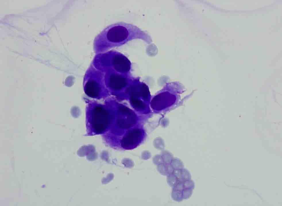 Rib, right posterior, CT-guided FNA: Diff-Quik stain Presentation material is