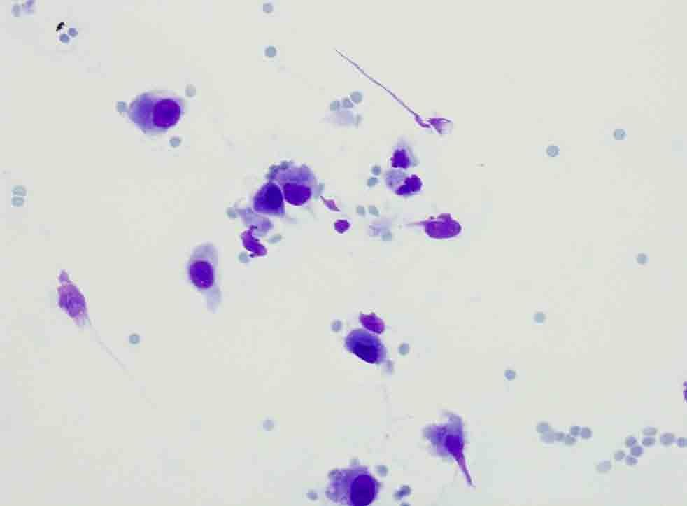 Case 4 Pleural based mass, CT-guided FNA: Diff-Quik Presentation material is stain