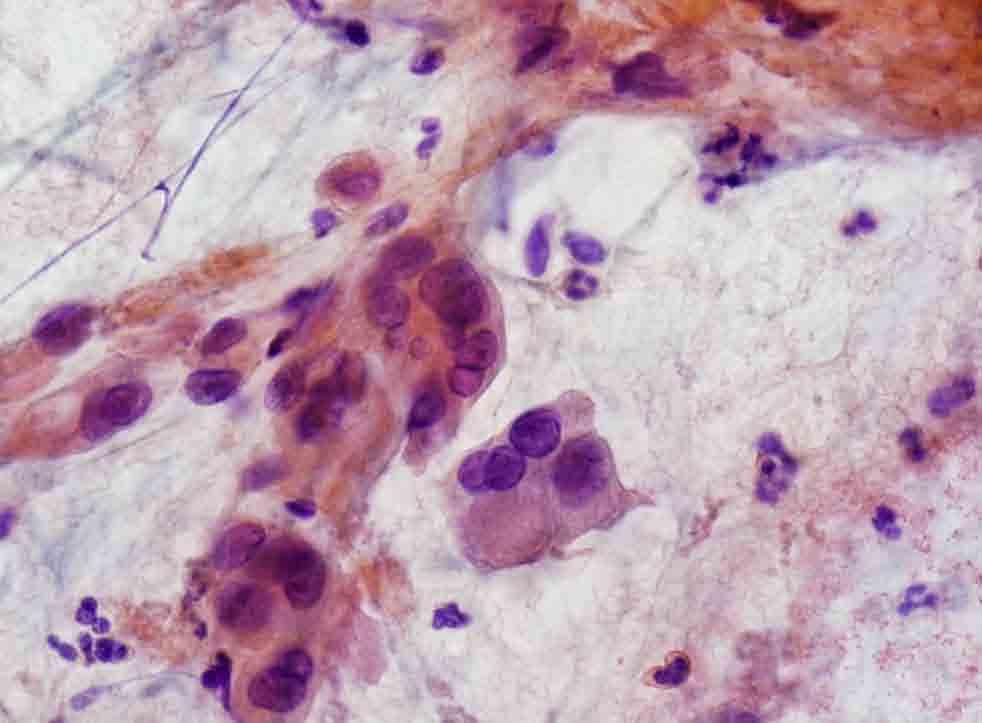 Pleural based mass, CT-guided FNA: Papanicolaou stain Presentation material is