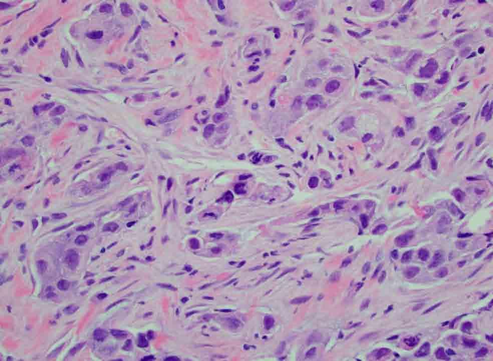Pleura, base mass, biopsy: H & E stain Presentation material is for