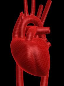 4 Modified Description 33225 - Insertion of pacing electrode, cardiac venous system, for left ventricular pacing, at time of insertion of pacing cardioverter-defibrillator
