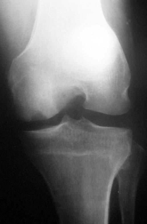 OSTEOCHONDRAL ALLOGRAFTS Incorporation Allograft bone is replaced by Host bone in 2-3 years