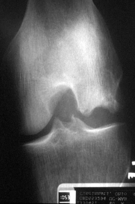 OSTEOCHONDRAL ALLOGRAFTS Considerations: Size of defect Availability of sizematched quality