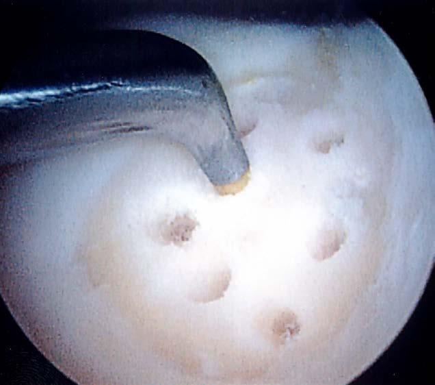 Focal cartilage defects in the knee pose a difficult clinical challenge Repair, regeneration