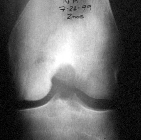 OSTEOCHONDRAL ALLOGRAFT NH CASE Follow-up at 2 months