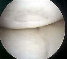 Despite numerous attempts at addressing the problem of chondral lesions,