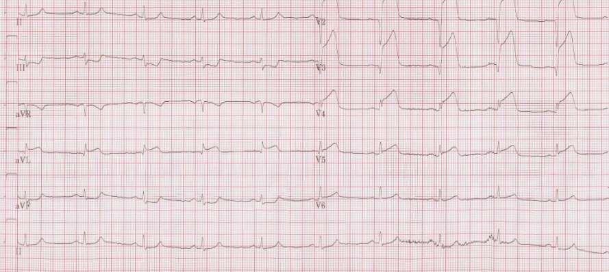 55 year old male smoker, presented with central chest pain of 60 minutes. Patient was apprehensive and diaphoretic, BP; 100/60, exam is otherwise normal. Q.