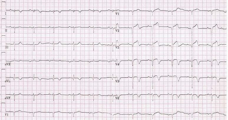 12 months later, the patient had an echocardiogram, and he comes back asking you to look up the result before him being seen by his cardiologist. He requested an ECG for reassurance Q.