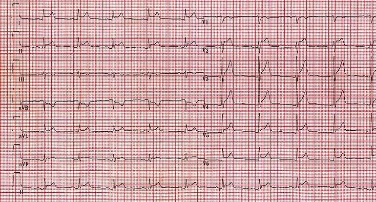 25 year old female with plueritic chest pain. Troponin is 400 Q.