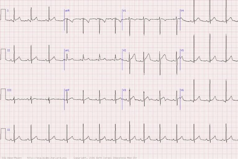 Q. This ECG from an 18 year old male shows all of the following, except; 1.