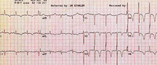 Note the ST depression and T-wave inversion in leads V 2 -V 6.