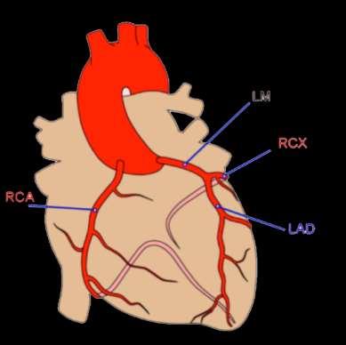 Infarct Localisation Left main artery occlusion: o diffuse ST-depression with ST elevation in AVR o very high risk Anterior wall: o ST elevation V1-V4. LAD.