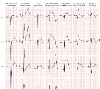 Differential diagnosis of ST elevation 1:LVH 2:LBBB 3: Pericarditis 4: High