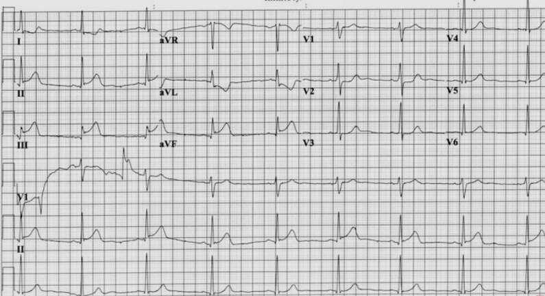 Sixty year old male with epigastric pain associated with nausea and vomiting. Chronic smoker. HbA1c of 65. BP is 90/70 Q. All of the following are true, except? 1. Patient has acute pericarditis 2.