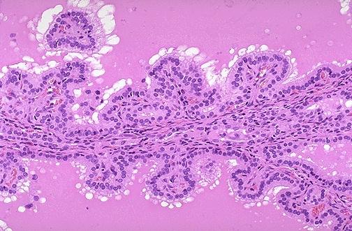 What structures appear abnormal in this tissue? C. PROLACTINOMA p37 pituitary adenoma https://med-vmicro.med.illinois.