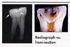 The left panel shows a conventional bitewing radiograph with an interproximal lesion on the