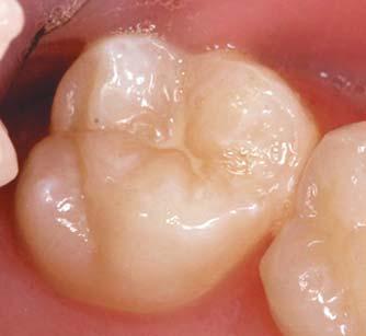 In the case of hidden caries, traditional diagnostic methods all too frequently