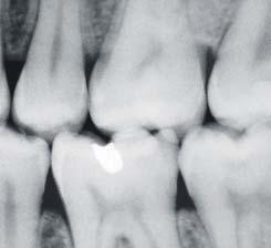 Incipient caries lesions that once began on the tooth s surface have now