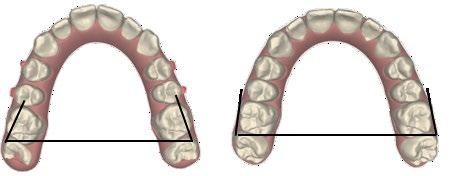 to be nearly parallel to each other on the ClinCheck. Subsequently, determine the treatment plan and consider that molar rotation with aligners alone is a highly predictable movement (Figure 1).