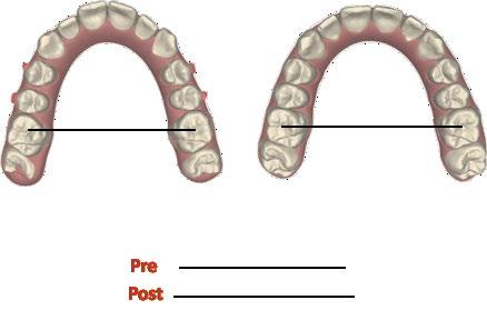If accurately followed, indications offered by the program are strategic to favor the mesial positioning of the mandible in both Class II div. 2 and div. 1 malocclusions (Figure 4).