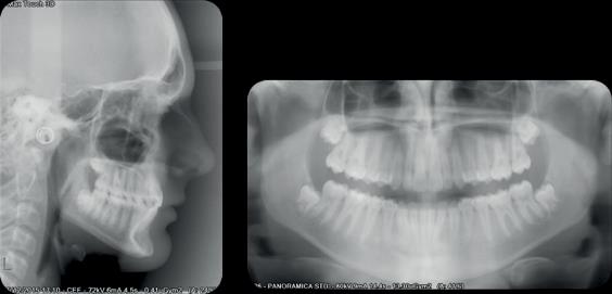 Upon refinement phase, in order to allow the mandible s anterior repositioning, Class II elastics were tied from a clear bonded button onto the surface of the upper canines to the metal button on the