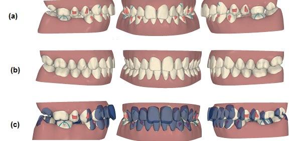 Treatment objectives: The main treatment objectives were: 1. to correct Class II dento-skeletal relationship; 2. to obtain an ideal overbite and overjet; 3.