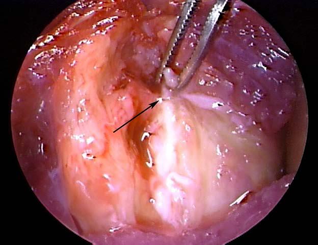 SURGICAL TECHNIQUE Incise ligament along its anterior margin to look at its underside Place an osteo-inductive or osteoconductive (not a