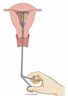 Overcoming LARC complications Tools such as alligator forceps and IUD hooks can aid device removal when the strings are not palpable FIGURE 1 In-office removal of malpositioned IUD Alligator forceps