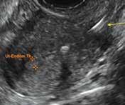 Overcoming LARC complications CONTINUED FROM PAGE 20 FIGURE 3 Sonography of IUD in the lower uterine segment Sagittal and 3D sonographic views of a copper IUD located in the lower uterine segment and
