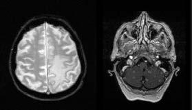 Flash Posters 5 F058 Cerebral and cerebellar tuberculomas in a 78-year-old woman: a case report A. Parralo, A. Lopez, N. Giraldo 2, J.J. Bravo 3, C. Valencia 3, A.