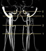 764 Flash Posters F360 The blood flow rate dynamics through the internal carotid arteries in patients with chronic cerebral ischemia using magnetic resonance imaging Y. Stankevich, O. Bogomyakova, L.