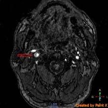 782 Flash Posters MRI: right internal carotid artery dissection Results: Two days after admission tongue deviation, weakness and difficulty swallowing developed while the headache and tongue oedema