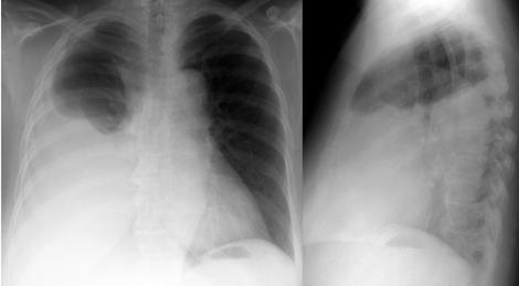 Hemothorax - continued CXR upright v supine CT more sensitive thoracostomy large bore