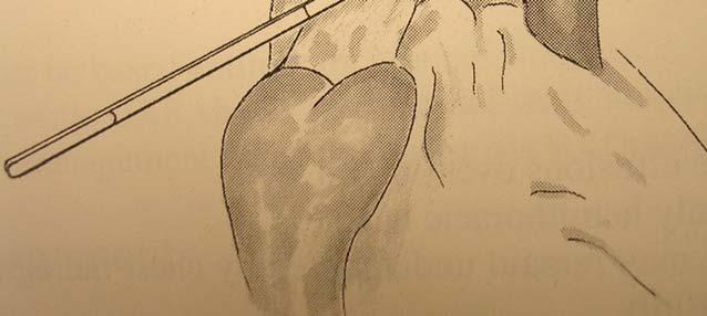 site distal to L subclavian avulsion