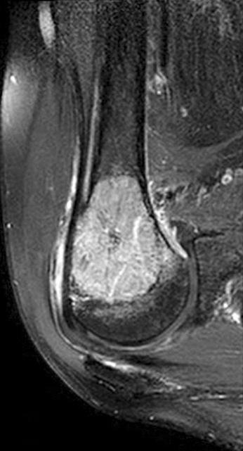 The nail was inserted carefully with special attention to avoid the proximal end of the nail impinging the rotator cuff tendons or the acromion.