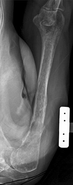 (B) The segmental defect was reconstructed using an intramedullary nail and cement. (C) Stable fixation was maintained for 18 months after reconstruction. preservation of the rotator cuff.