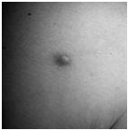 Primary Lesions Papule - up to 1 cm in size, circumscribed, elevated, superficial, solid lesions.