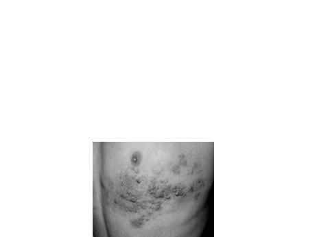 Examples: tumor stage of mycosis fungoids, larger epitheliomas Primary Lesions Cont d