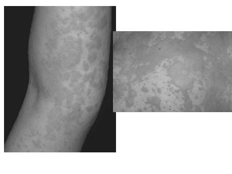 American Osteopathic College of Occupational and Preventive Medicine Urticaria Urticaria Local or generalized hives E.g. latex allergy Nodules Nodules Foreign body (e.