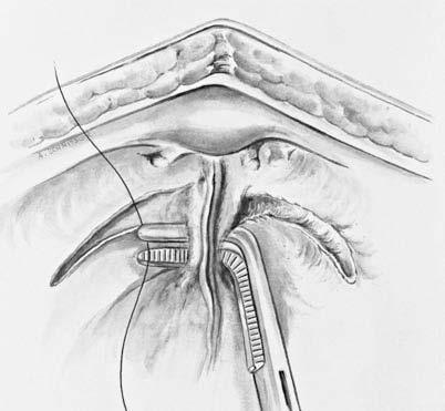 597 Fig. 8-1-15 The entire clitoral venous plexus is ligated. The palpable bladder catheter acts as a guide, with posterior and periurethral dissection along it.