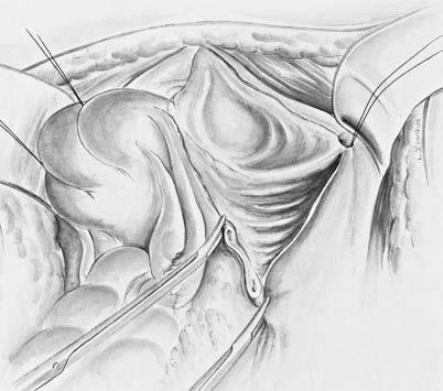 Anterior Exenteration Only examples of exenteration procedures can be described here as, like typical ovarian cancer surgery, they are highly individualized.