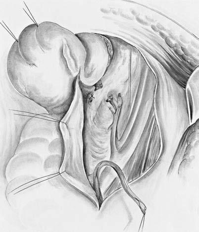 Some authors ligate the ureter distally, which then distends in the course of the operation, facilitating reimplantation during the reconstructive phase.