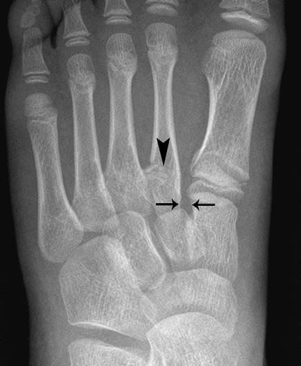Common Injuries in the Lower limb Fig 2.37 X-ray showing Lisfranc injury. 2 Assessment and diagnosis of the injured athlete Special tests: Check dorsalis pedis artery is not compromised.
