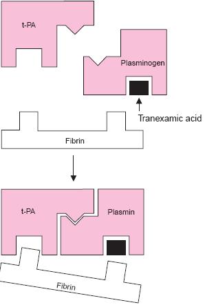 Tranexamic acid reduces fibrinolysis Tranexamic