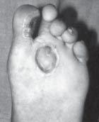 If the plantar ulcer or sinus does not involve the joint, Figure 10: Flap healed covering the defect we have