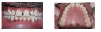 Treatment was then started using fixed orthodontic mechanotherapy using a MBT prescription. Maxillary anterior spacing was closed on a 0.019 x 0.