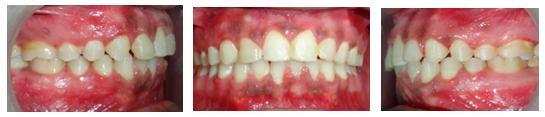 Multi-disciplinary treatment approach involving orthodontists and periodontist can prove to be useful in solving various periodontal problems encountered during orthodontic treatment.