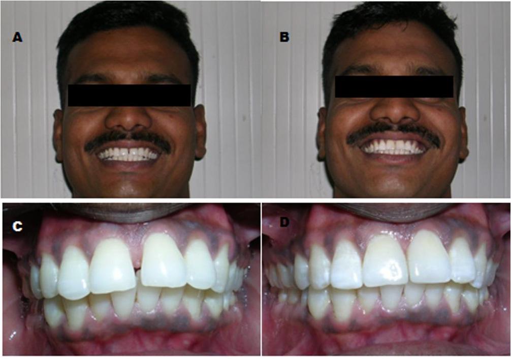 Figure 1: Correction of midline diastema with conservative composite build-up and recountouring of upper anterior teeth.